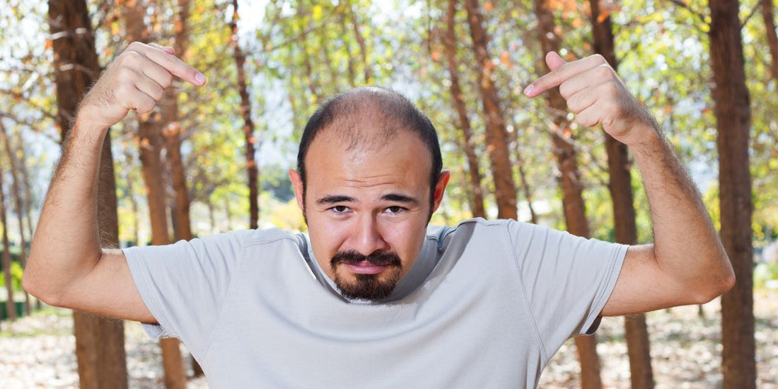 La calvitie masculine, un marché lucra'tif sans en avoir l'hair